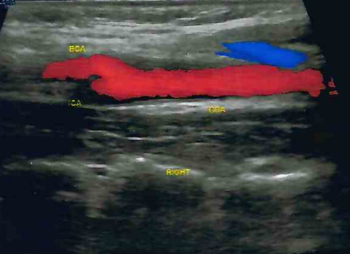 carotid