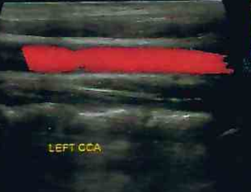 carotid
