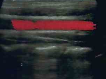 carotid
