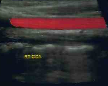 carotid