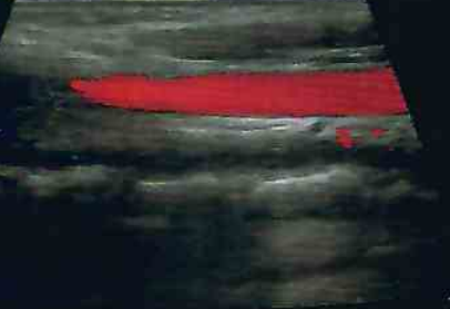 carotid