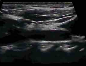 carotid