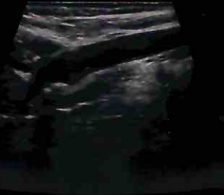 carotid