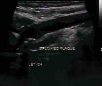carotid