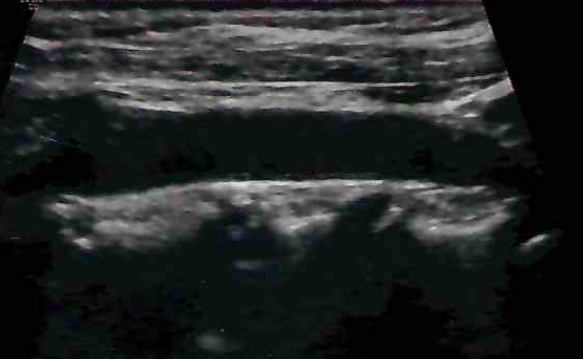 carotid