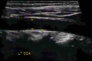 carotid