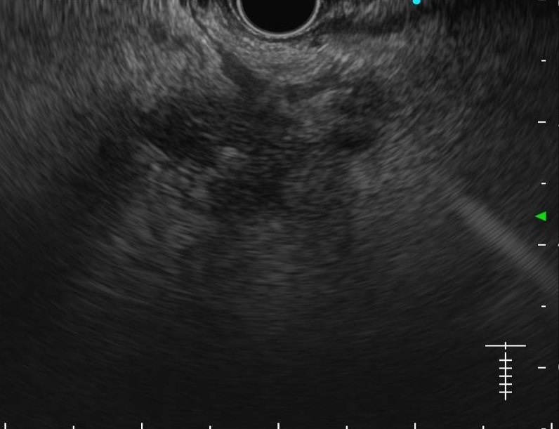 pancreas