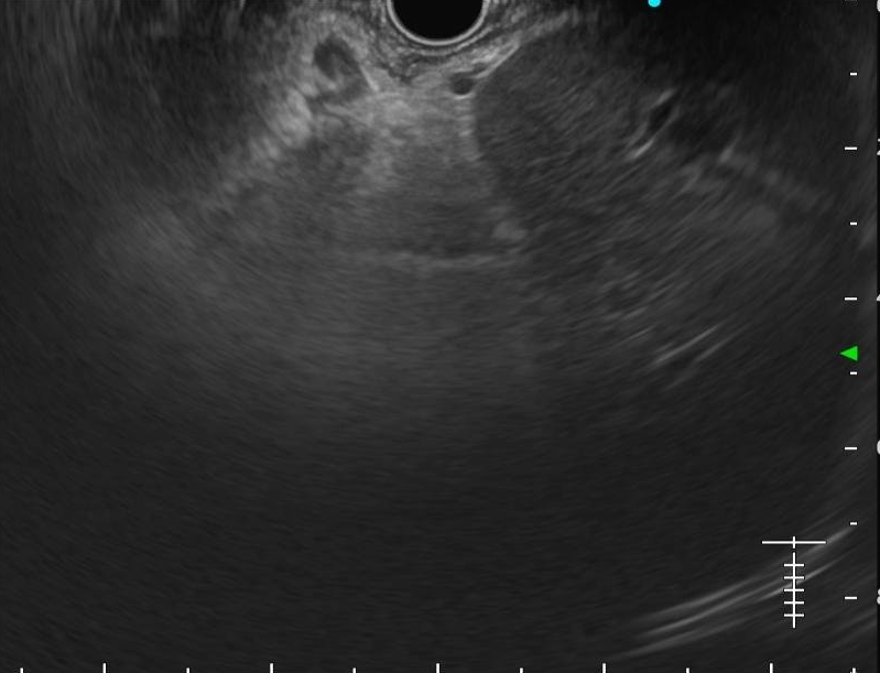 pancreas