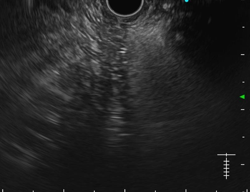 pancreas