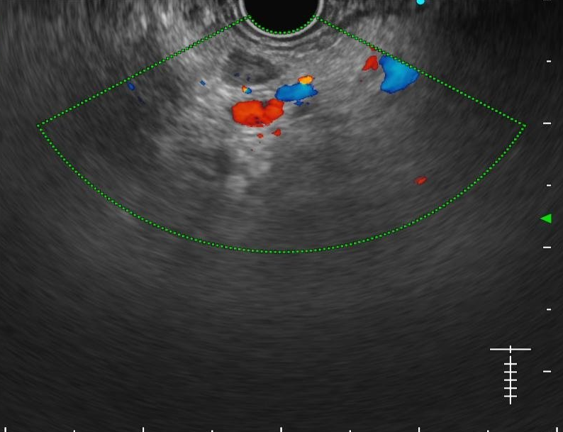 pancreas