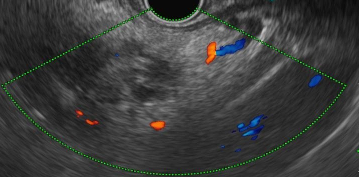 pancreas
